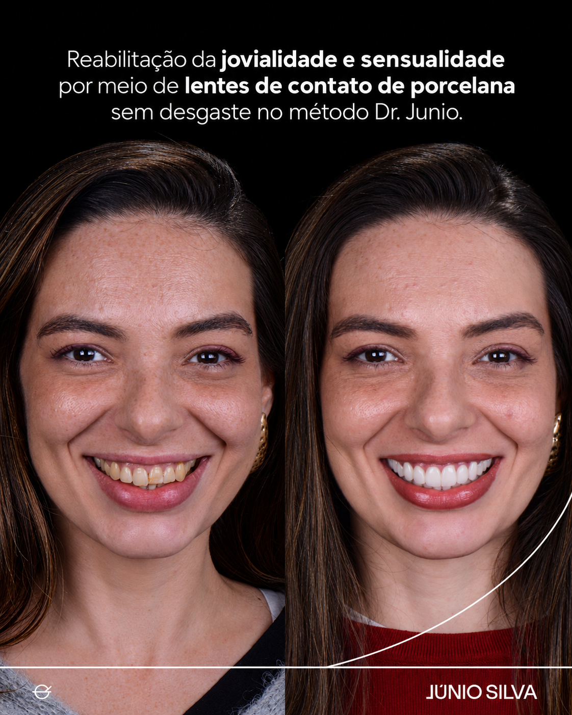 Caso clínico — reabilitação das sequelas do bruxismo com preservação estética, antes e depois
